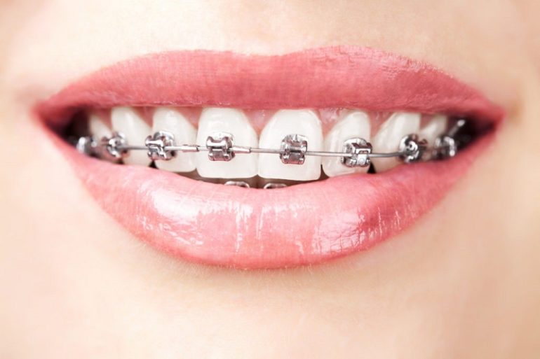 Girl in braces icon 