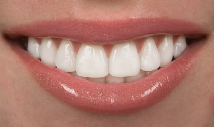 Composite Veneers