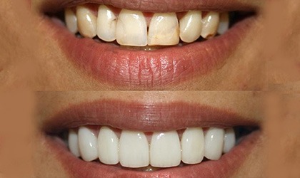 Porcelain Veneers