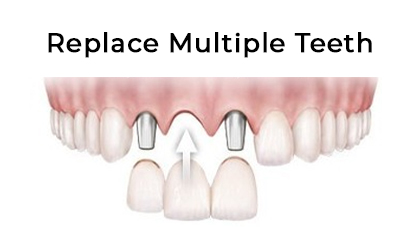 Replace multiple teeth 