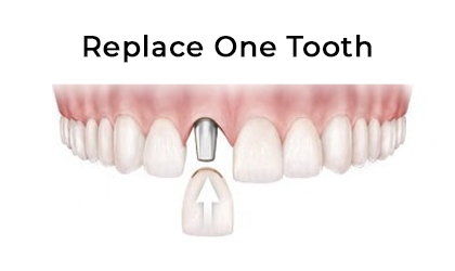 Replace one tooth image