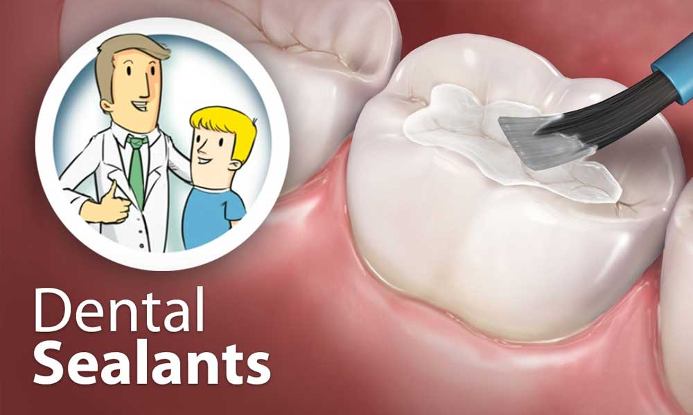 Sealants