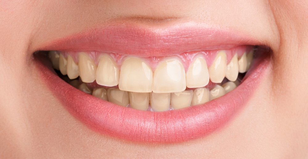 Teeth Whitening Cost in Andheri West