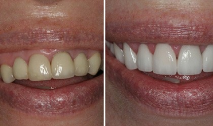Teeth Re-contouring
